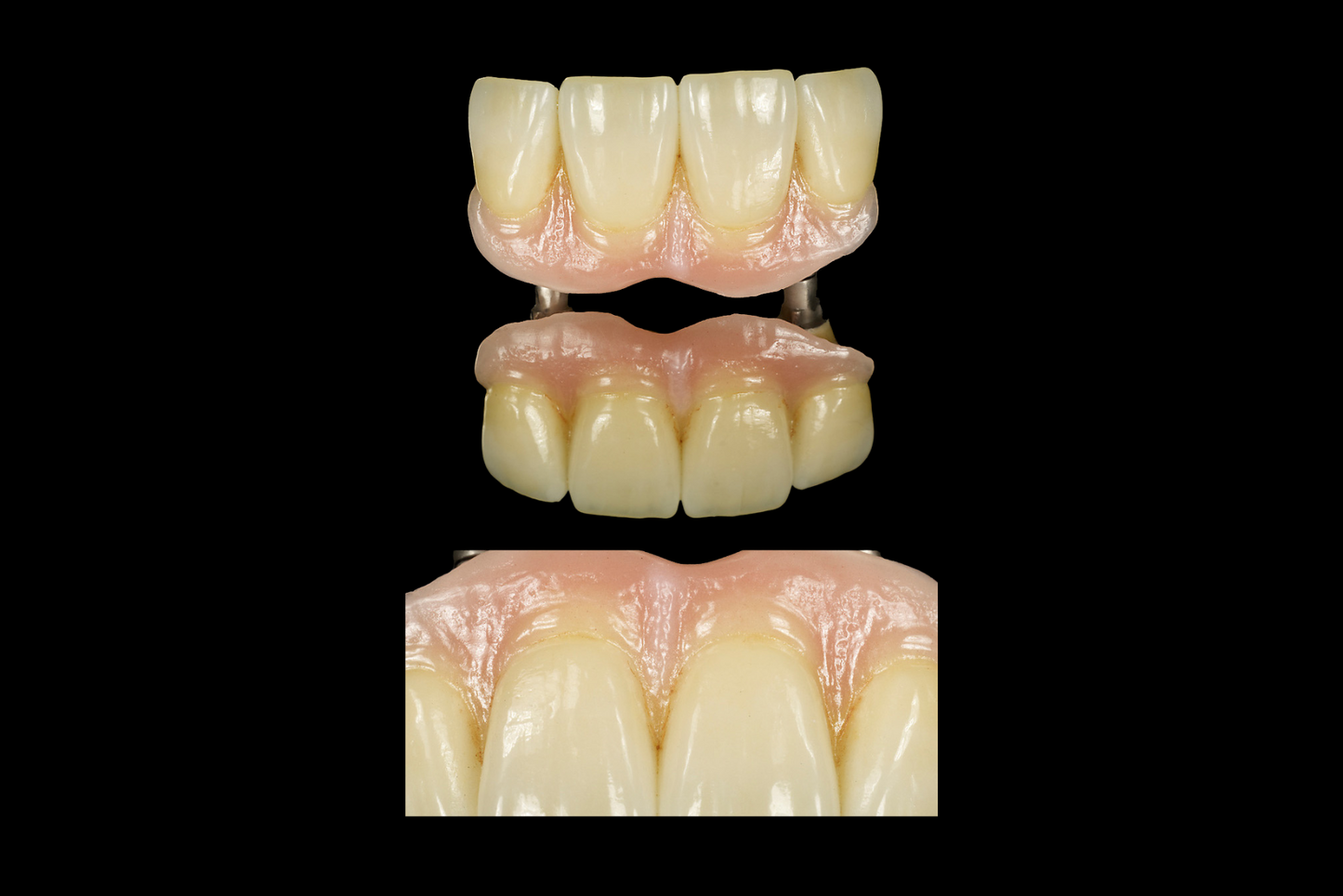 Full Arch Restorative and Bars
